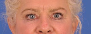 Blepharoplasty Before & After Gallery - Patient 893460 - Image 2