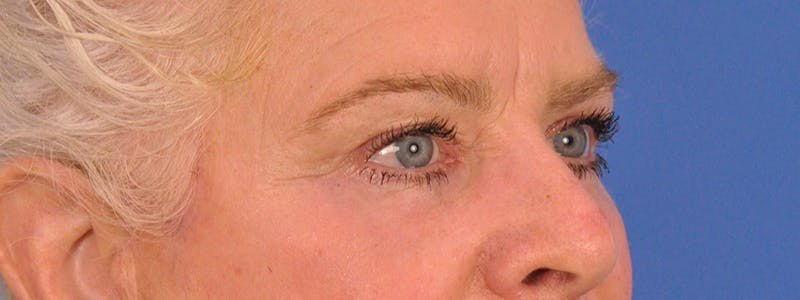 Blepharoplasty Before & After Gallery - Patient 893460 - Image 4