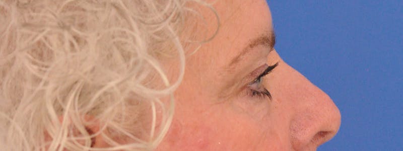 Blepharoplasty Before & After Gallery - Patient 893460 - Image 5