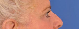 Blepharoplasty Before & After Gallery - Patient 893460 - Image 6
