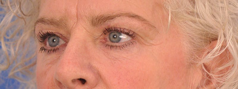 Blepharoplasty Before & After Gallery - Patient 893460 - Image 7