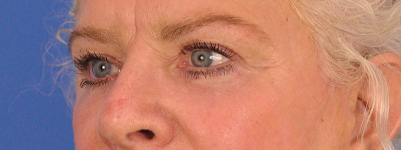 Blepharoplasty Before & After Gallery - Patient 893460 - Image 8