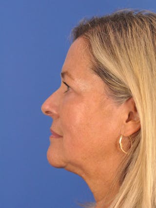 CO2RE Laser Before & After Gallery - Patient 317708 - Image 8