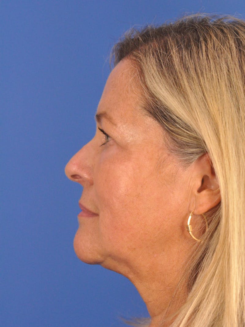CO2RE Laser Before & After Gallery - Patient 317708 - Image 8