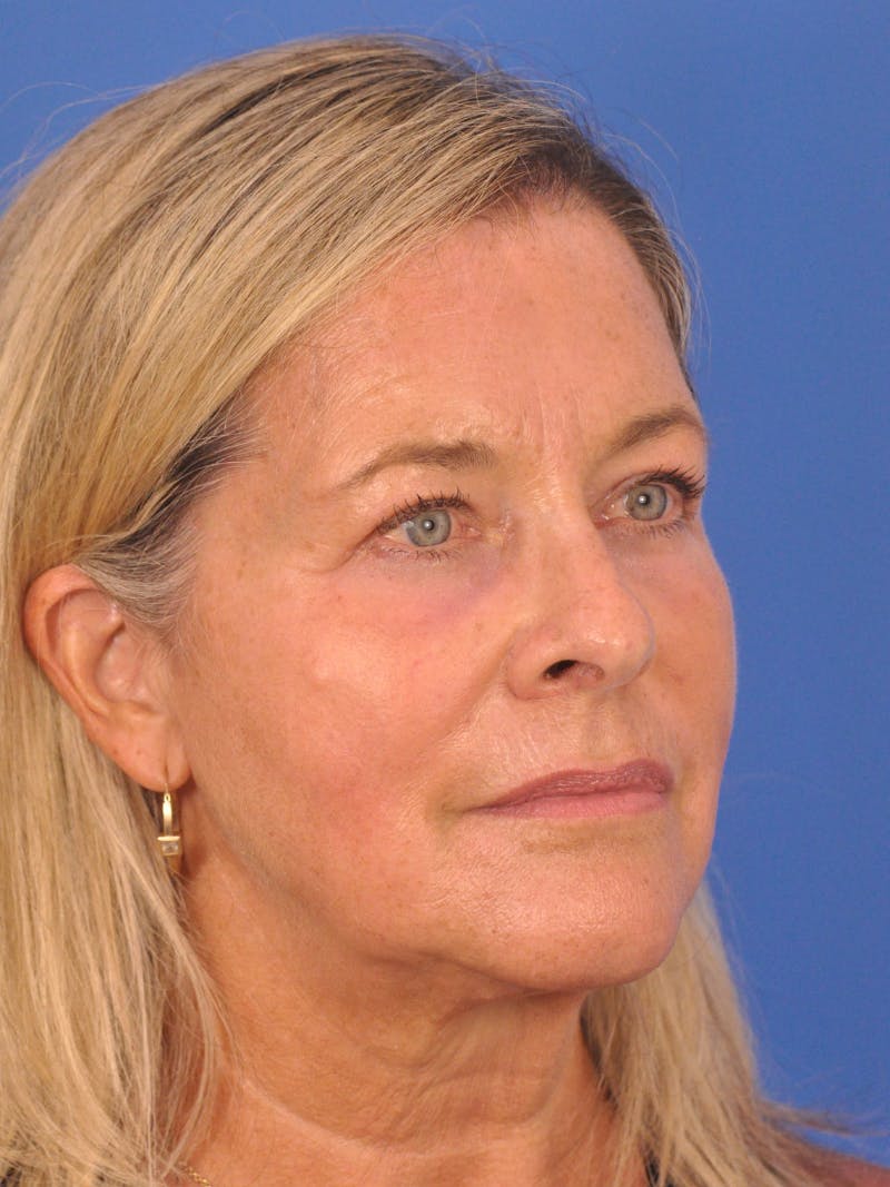 CO2RE Laser Before & After Gallery - Patient 317708 - Image 6