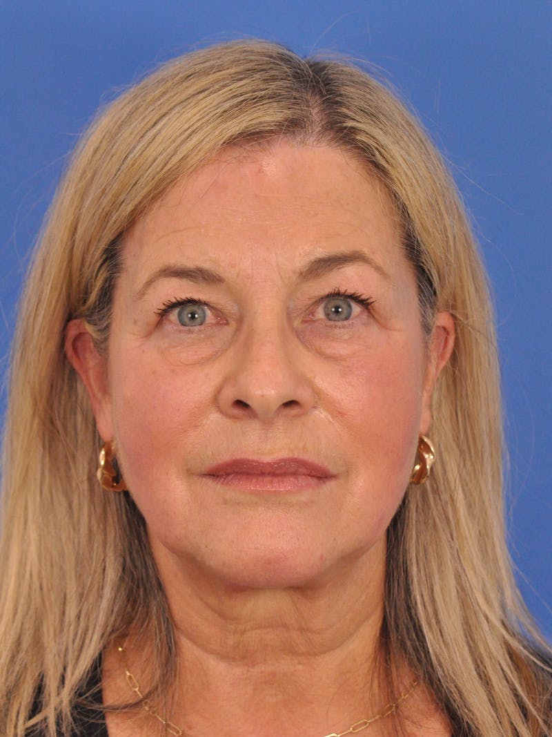 CO2RE Laser Before & After Gallery - Patient 317708 - Image 1