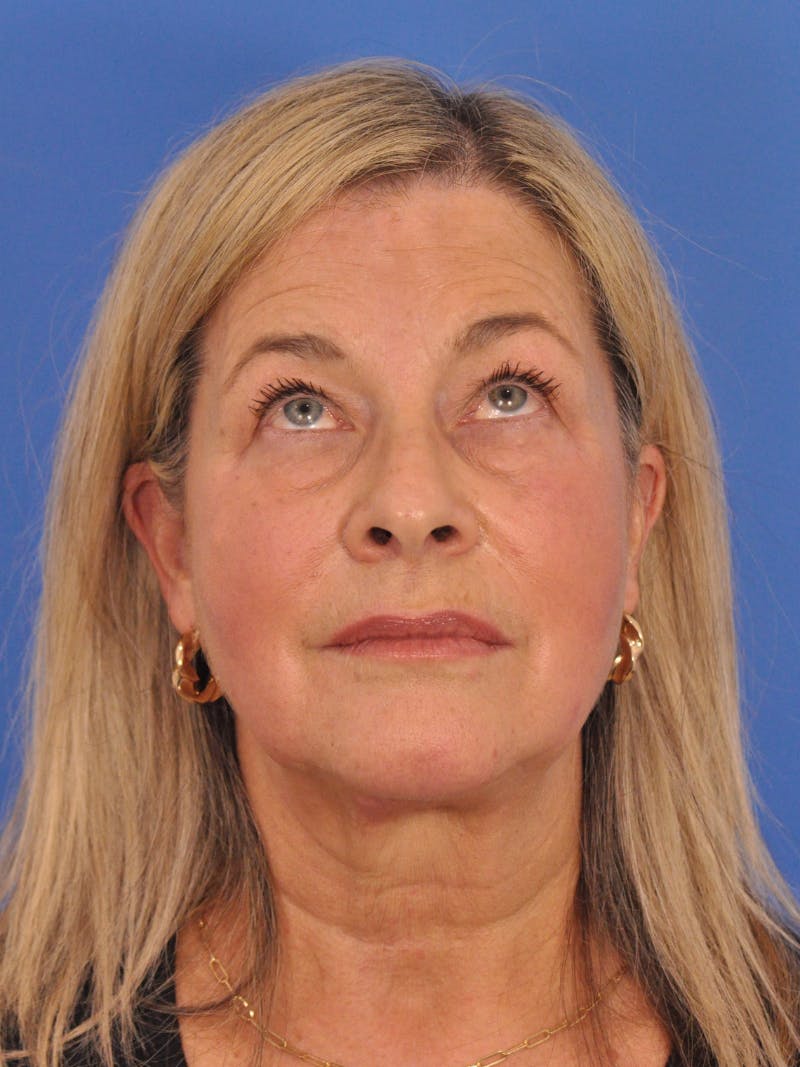 CO2RE Laser Before & After Gallery - Patient 317708 - Image 11