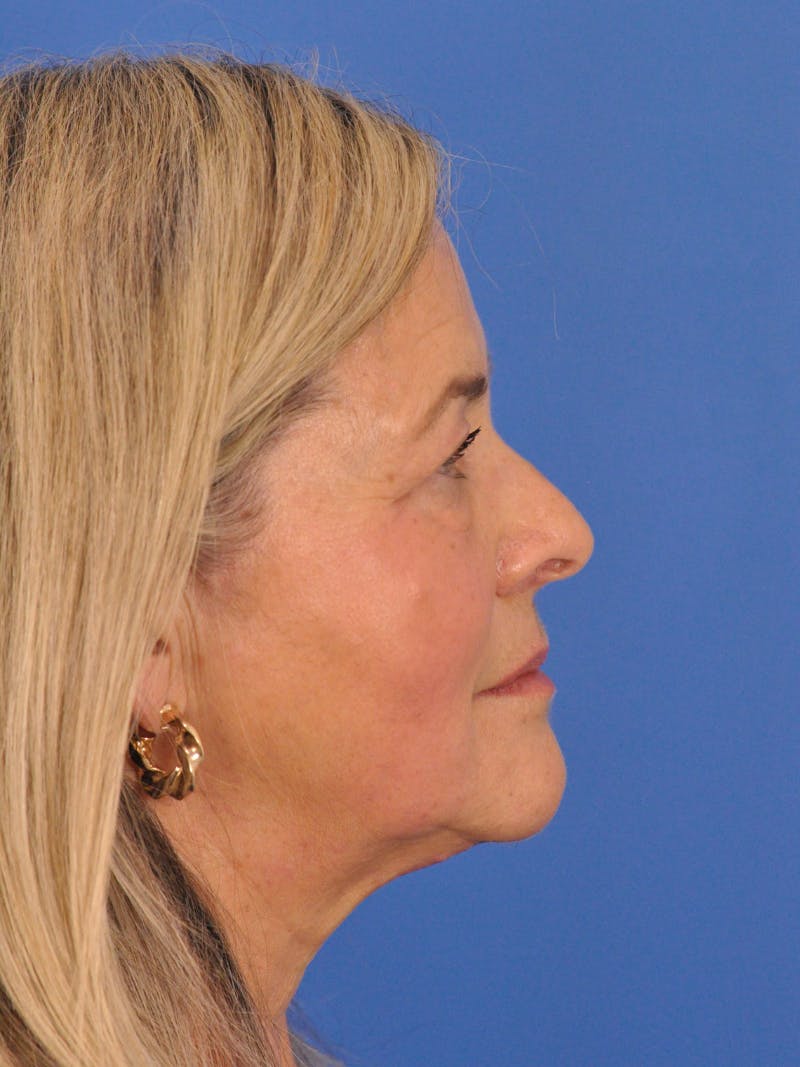 CO2RE Laser Before & After Gallery - Patient 317708 - Image 3