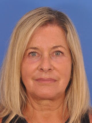 CO2RE Laser Before & After Gallery - Patient 317708 - Image 2