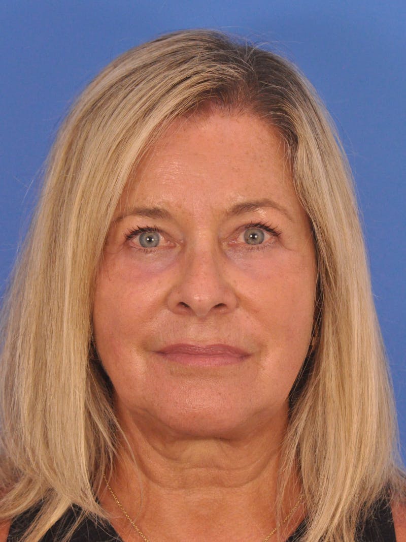 CO2RE Laser Before & After Gallery - Patient 317708 - Image 2