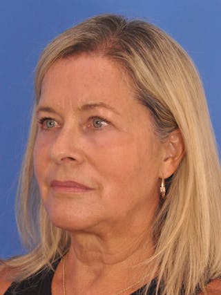 CO2RE Laser Before & After Gallery - Patient 317708 - Image 10