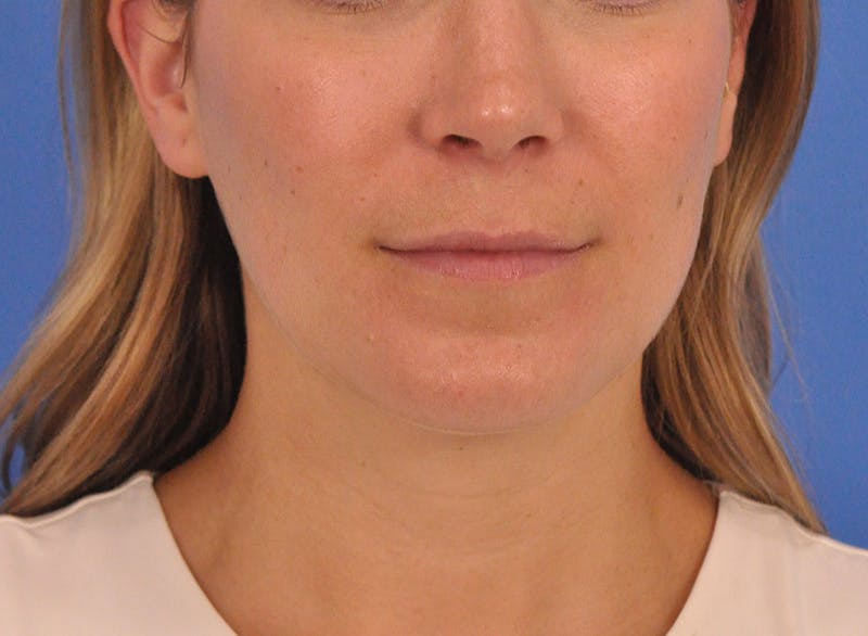 Cheek Filler Before & After Gallery - Patient 187973 - Image 1