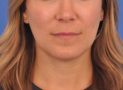 Cheek Filler Before & After Gallery - Patient 187973 - Image 2