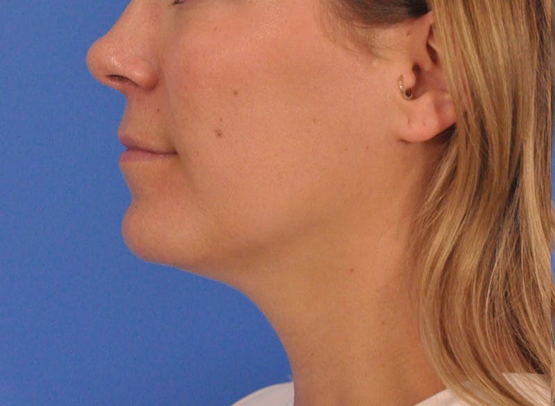 Cheek Filler Before & After Gallery - Patient 187973 - Image 15