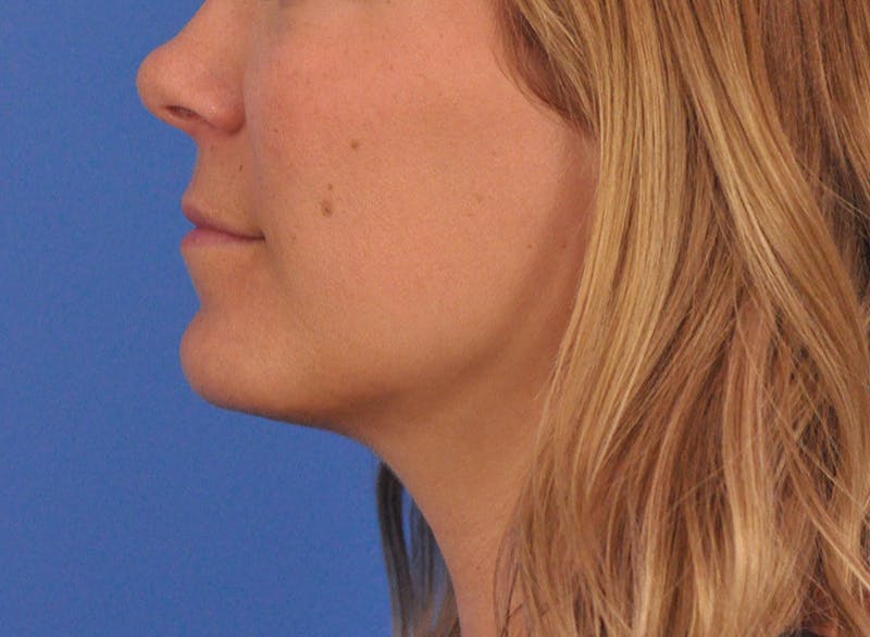 Cheek Filler Before & After Gallery - Patient 187973 - Image 16