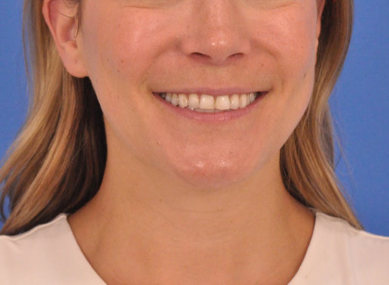 Cheek Filler Before & After Gallery - Patient 187973 - Image 3