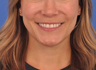 Cheek Filler Before & After Gallery - Patient 187973 - Image 4