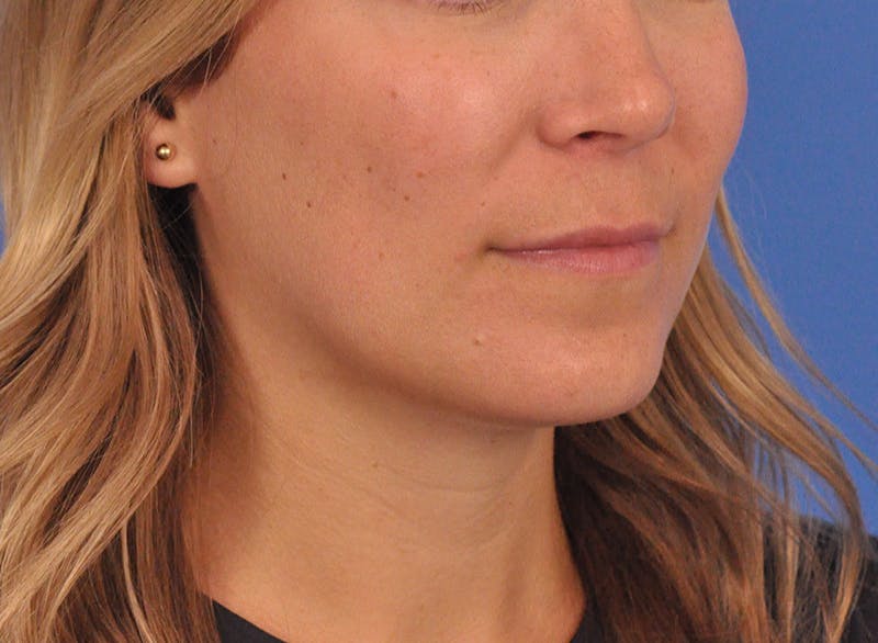 Cheek Filler Before & After Gallery - Patient 187973 - Image 6