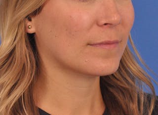 Cheek Filler Before & After Gallery - Patient 187973 - Image 6