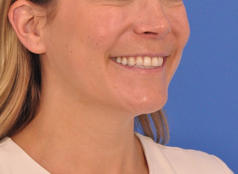 Cheek Filler Before & After Gallery - Patient 187973 - Image 7