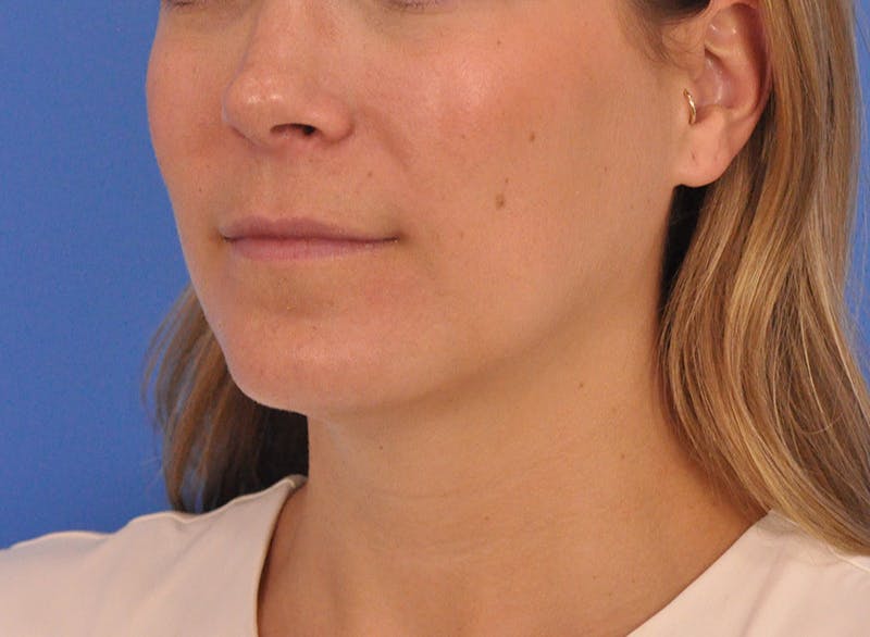 Cheek Filler Before & After Gallery - Patient 187973 - Image 11