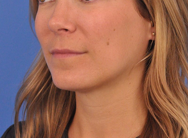 Cheek Filler Before & After Gallery - Patient 187973 - Image 12