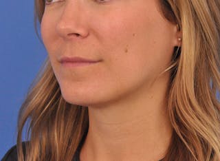 Cheek Filler Before & After Gallery - Patient 187973 - Image 12