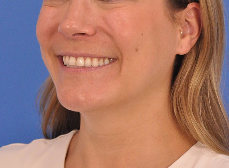 Cheek Filler Before & After Gallery - Patient 187973 - Image 13