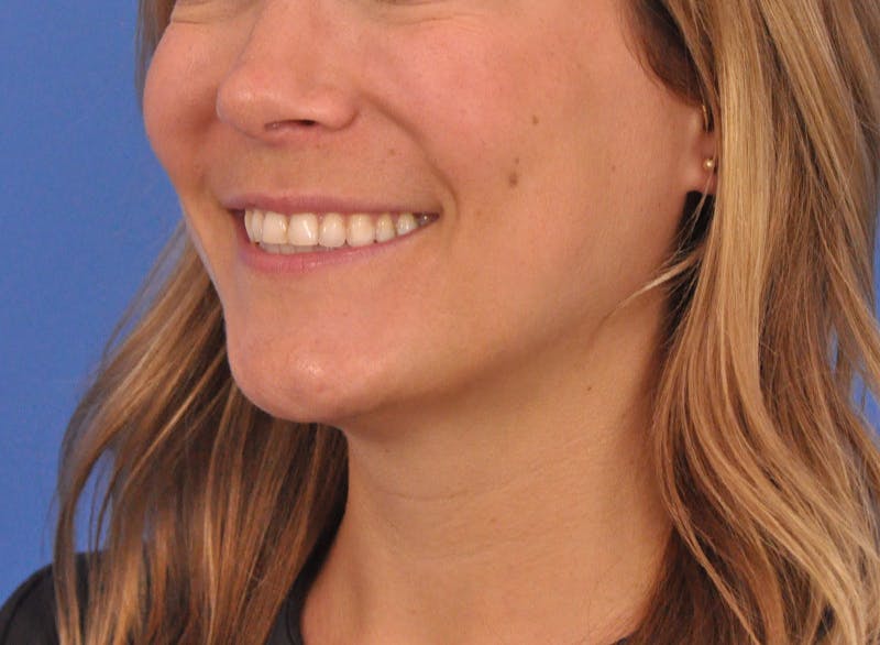 Cheek Filler Before & After Gallery - Patient 187973 - Image 14