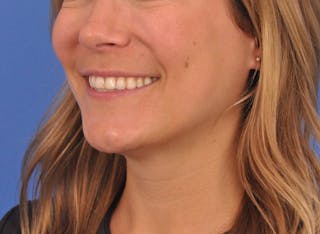 Cheek Filler Before & After Gallery - Patient 187973 - Image 14