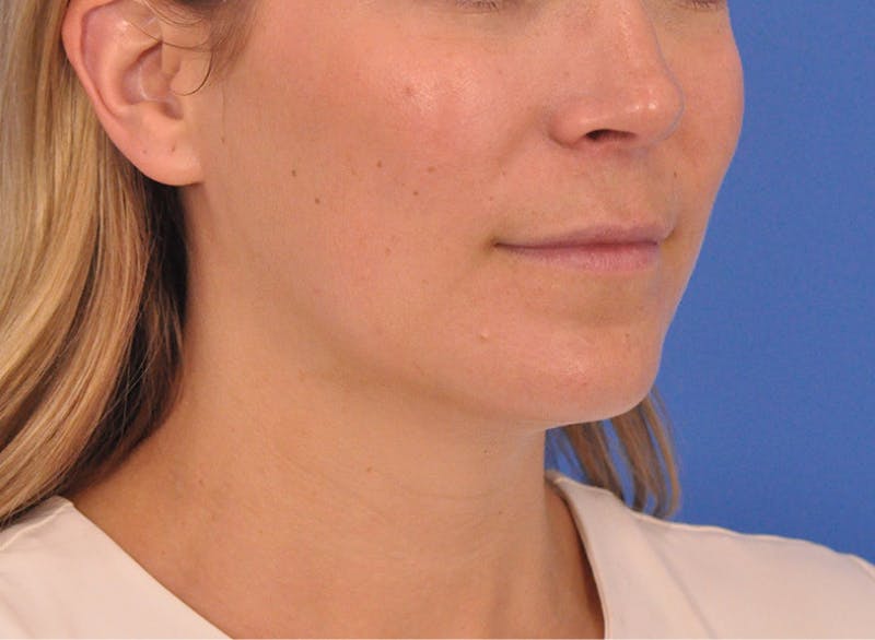 Cheek Filler Before & After Gallery - Patient 187973 - Image 5