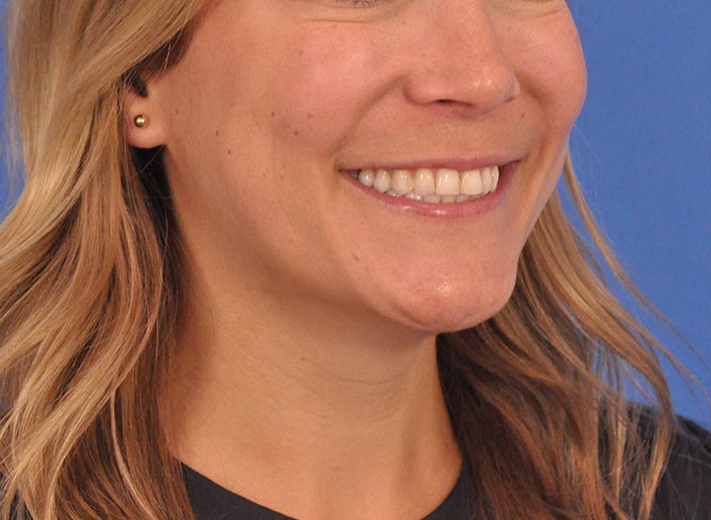 Cheek Filler Before & After Gallery - Patient 187973 - Image 8