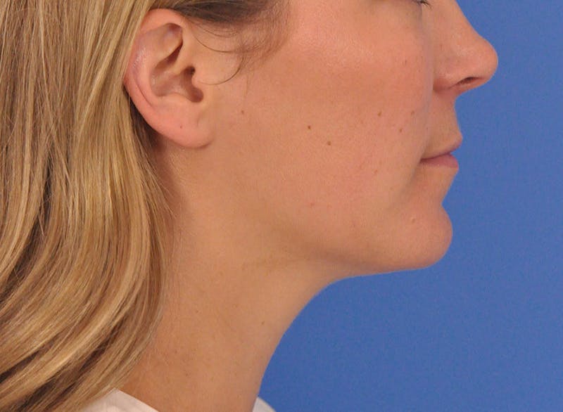 Cheek Filler Before & After Gallery - Patient 187973 - Image 9
