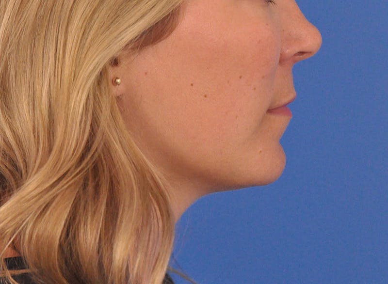 Cheek Filler Before & After Gallery - Patient 187973 - Image 10