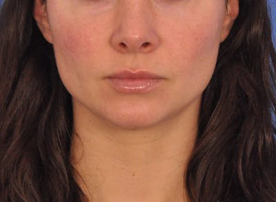 Cheek Filler Before & After Gallery - Patient 385411 - Image 2