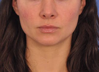 Cheek Filler Before & After Gallery - Patient 385411 - Image 2