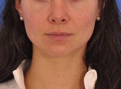 Cheek Filler Before & After Gallery - Patient 385411 - Image 1