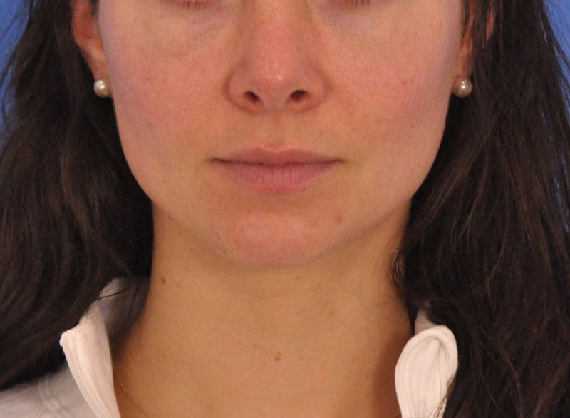 Cheek Filler Before & After Gallery - Patient 385411 - Image 1