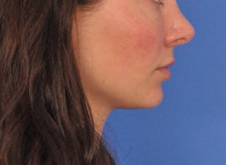 Cheek Filler Before & After Gallery - Patient 385411 - Image 8