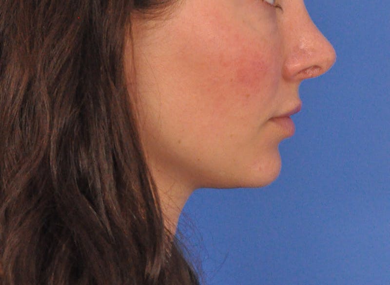 Cheek Filler Before & After Gallery - Patient 385411 - Image 8