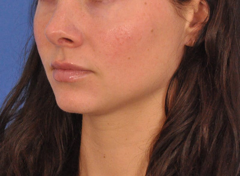 Cheek Filler Before & After Gallery - Patient 385411 - Image 10