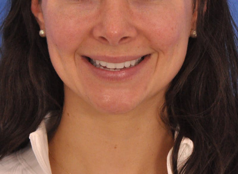 Cheek Filler Before & After Gallery - Patient 385411 - Image 3