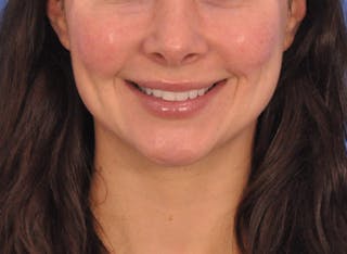 Cheek Filler Before & After Gallery - Patient 385411 - Image 4