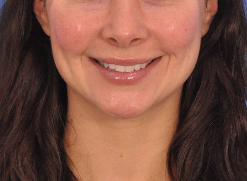 Cheek Filler Before & After Gallery - Patient 385411 - Image 4