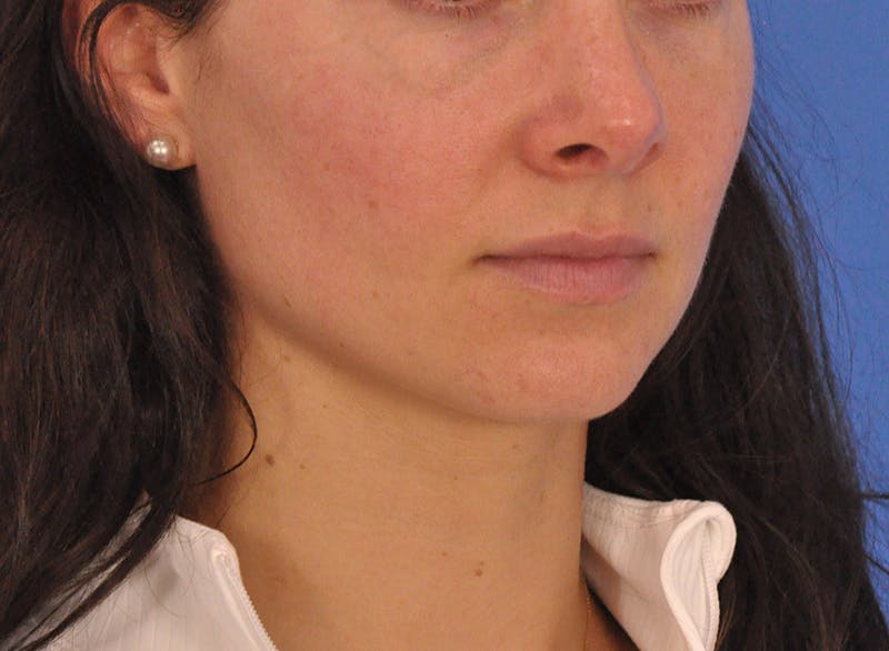 Cheek Filler Before & After Gallery - Patient 385411 - Image 5