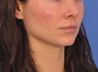 Cheek Filler Before & After Gallery - Patient 385411 - Image 6