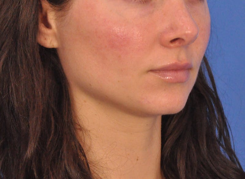 Cheek Filler Before & After Gallery - Patient 385411 - Image 6