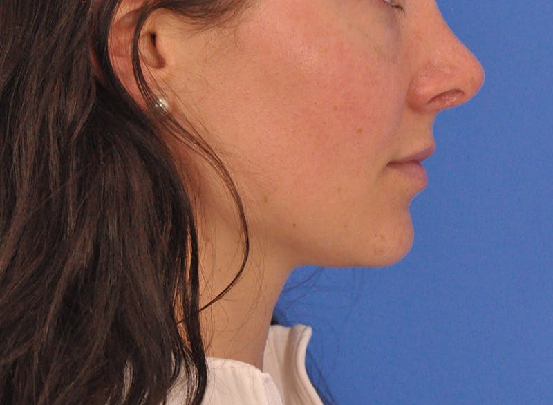 Cheek Filler Before & After Gallery - Patient 385411 - Image 7