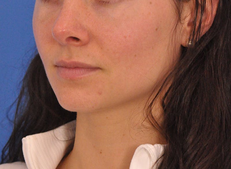 Cheek Filler Before & After Gallery - Patient 385411 - Image 9