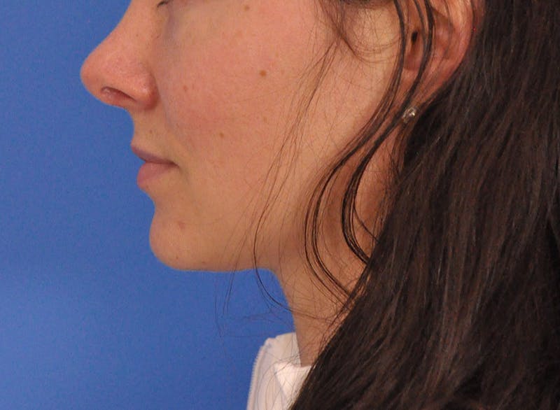 Cheek Filler Before & After Gallery - Patient 385411 - Image 11